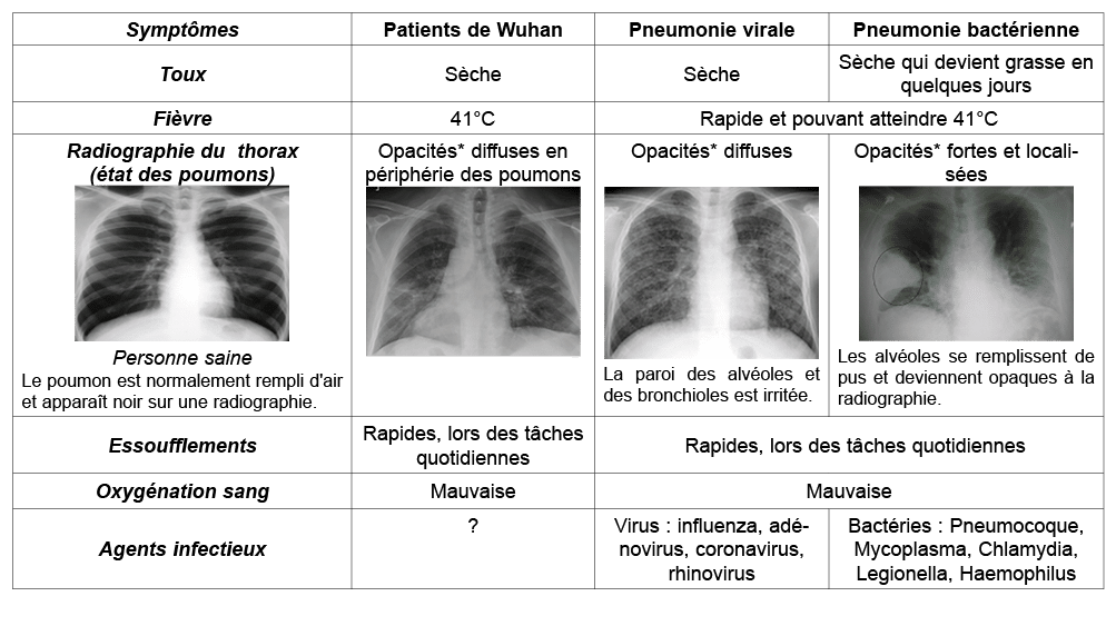Sympt mes,Patients de Wuhan,Pneumonie virale,Pneumonie bact rienne,Toux,S che,S che,S che qui devient grasse en quelq...