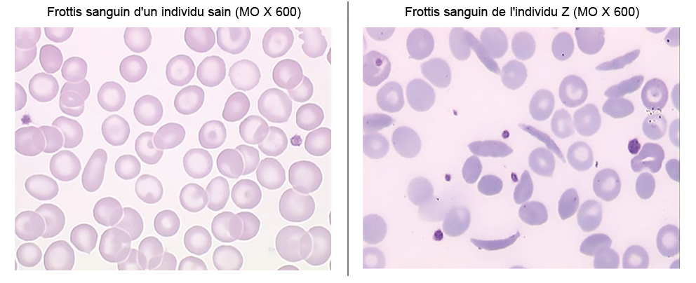 Frottis sanguin d'un individu sain (MO X 600),Frottis sanguin de l'individu Z (MO X 600), , 
